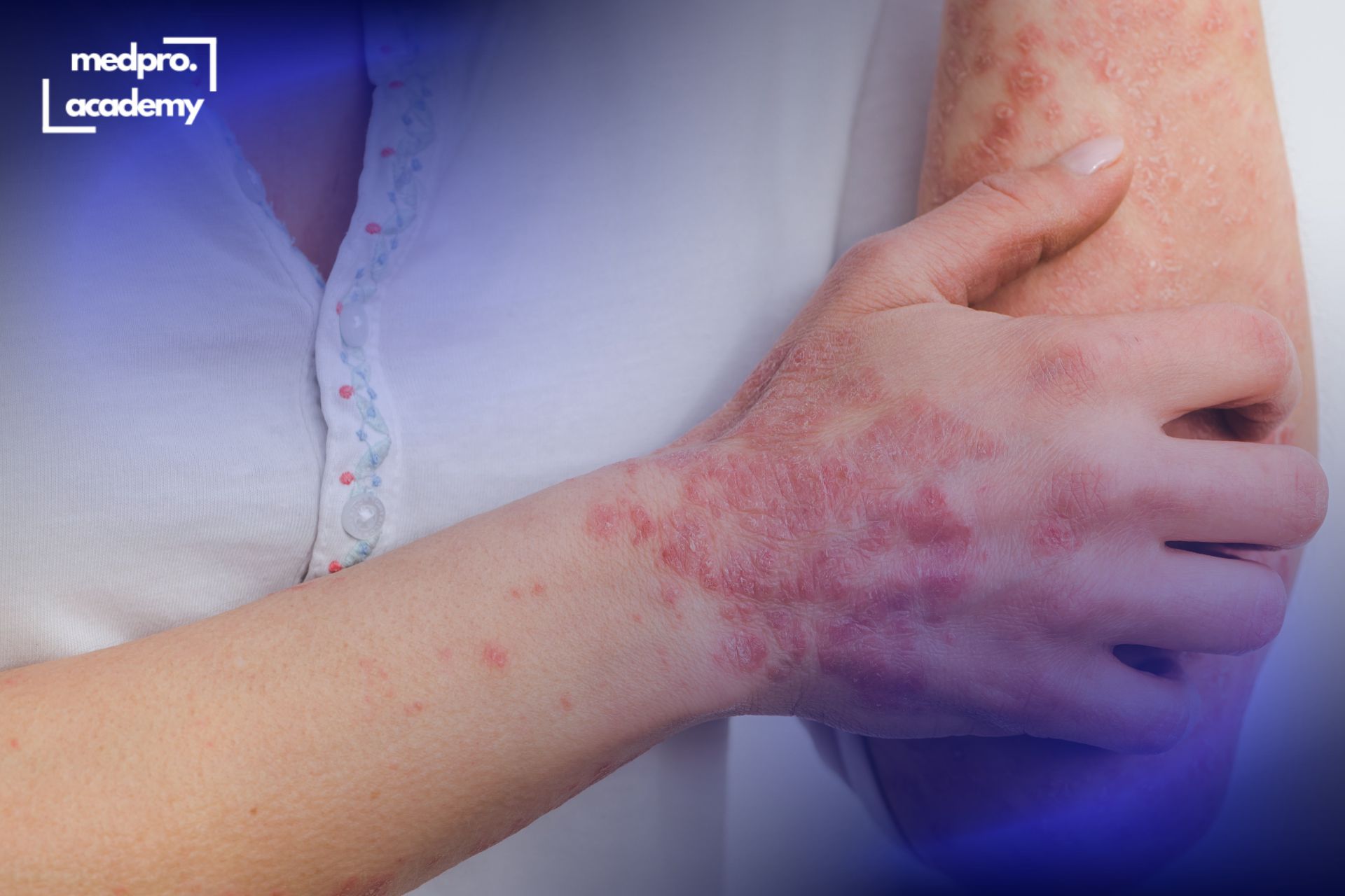 2Атопічний дерматит